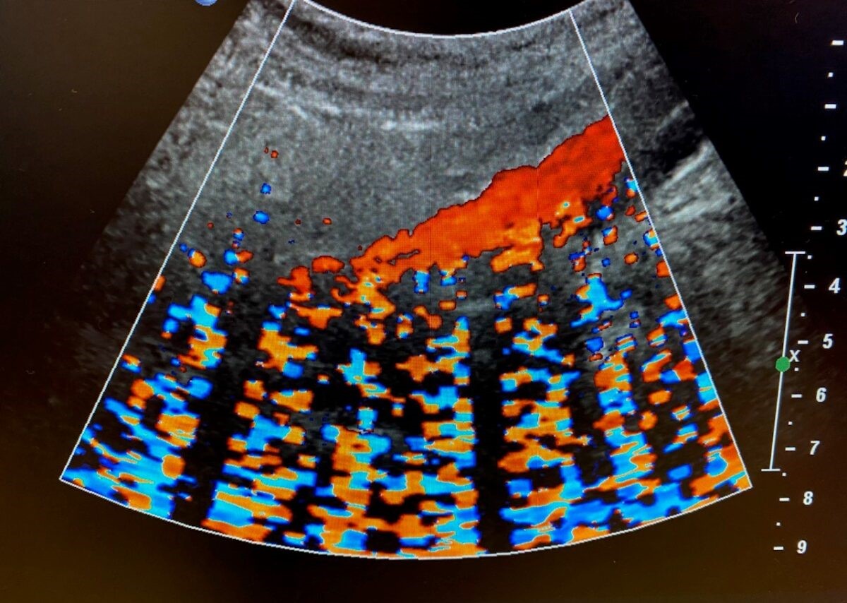 Ultrasound Artifacts