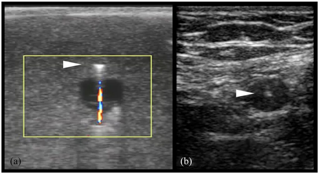 Ultrasound Artifacts