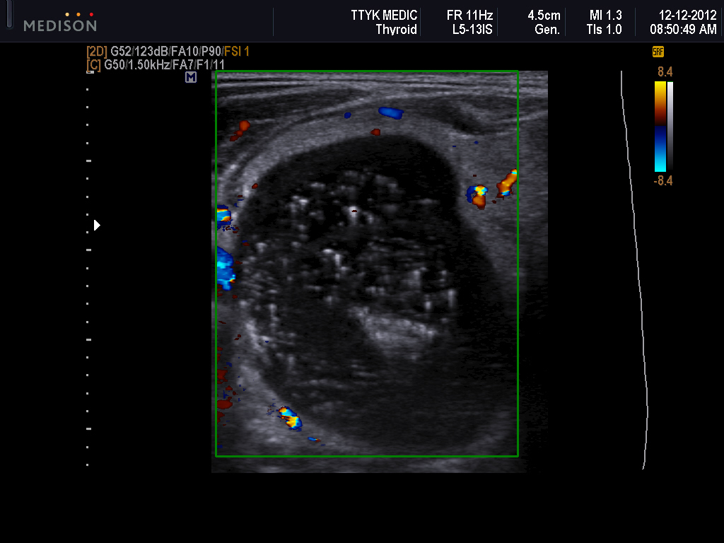 Ultrasound Artifacts