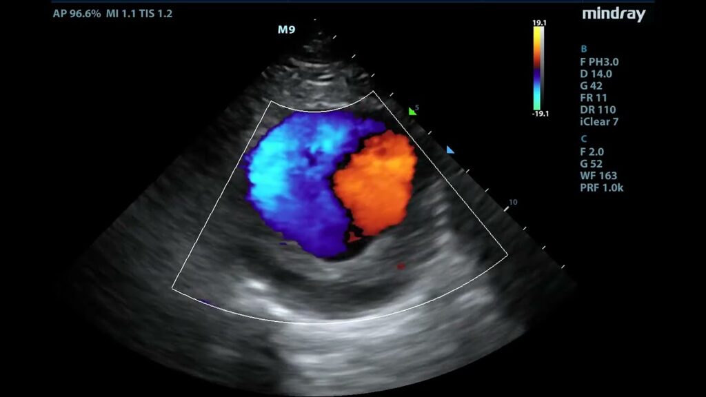 Ultrasound Modes